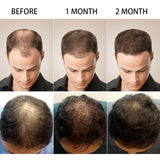 HULIANFU PURC Hair Growth Products Prevent Hair Loss Scalp Treatments Fast Growing Hair Products for Men Women